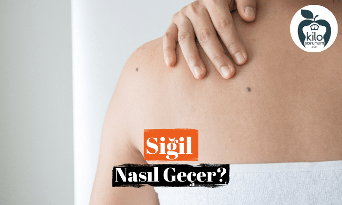 Siğil Nasıl Geçer?